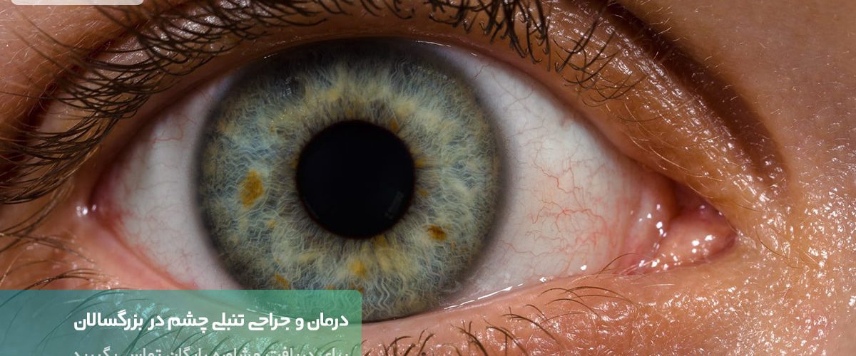 عمل جراحی تنبلی چشم در بزرگسالان